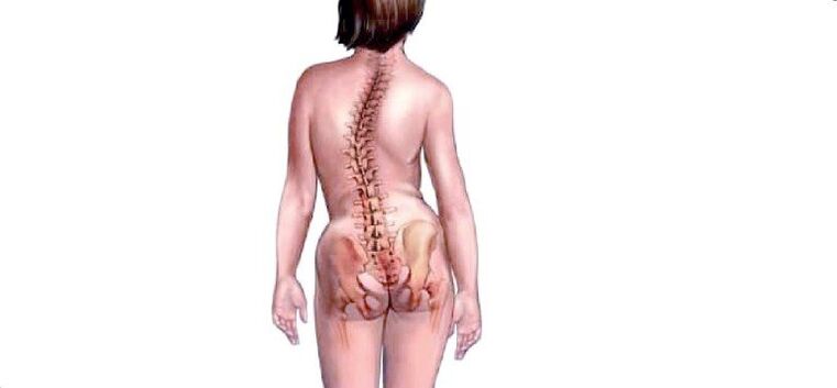 osteokondroz