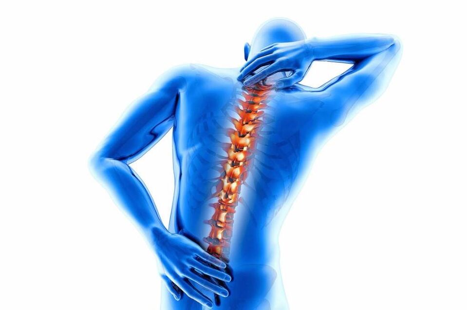 Osteokondroz hastalığına intervertebral disklerin incelmesi eşlik eder